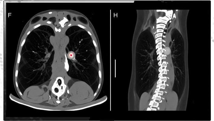 CT scan displayed on radiology workstation monitor